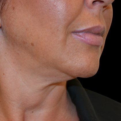 Liposuction-Face Before & After Patient #17287