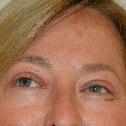 Blepharoplasty Before & After Patient #17269