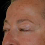 Blepharoplasty Before & After Patient #17269