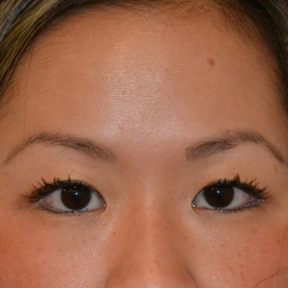 Blepharoplasty Before & After Patient #17274