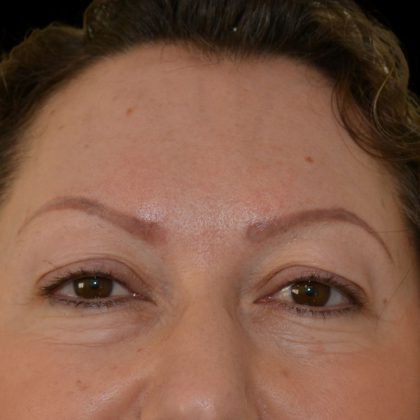 Blepharoplasty Before & After Patient #17280