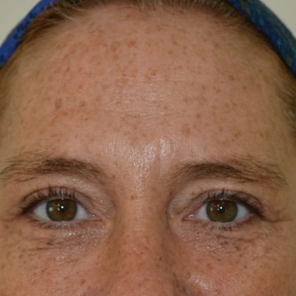 Blepharoplasty Before & After Patient #17285