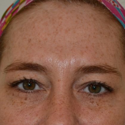 Blepharoplasty Before & After Patient #17285