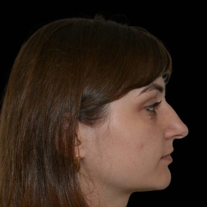 Rhinoplasty Before & After Patient #17125