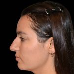 Rhinoplasty Before & After Patient #17132