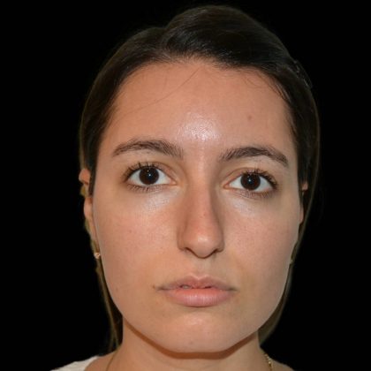 Rhinoplasty Before & After Patient #17132