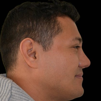 Rhinoplasty Before & After Patient #17147