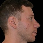 Rhinoplasty Before & After Patient #17154