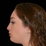 Rhinoplasty Before & After Patient #17161