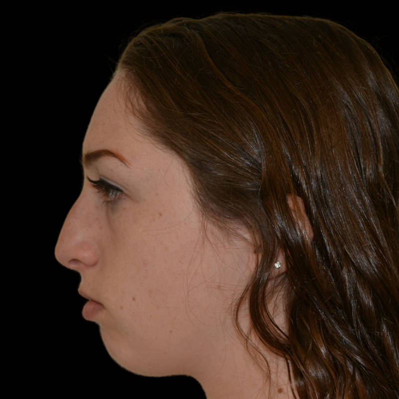 Rhinoplasty Before & After Patient #17161
