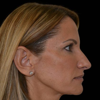 Rhinoplasty Before & After Patient #17176