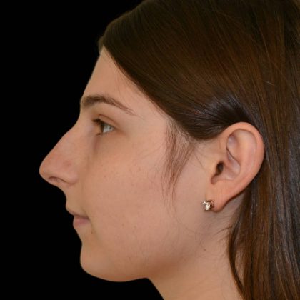 Rhinoplasty Before & After Patient #17188