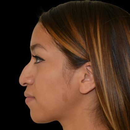 Rhinoplasty Before & After Patient #17200