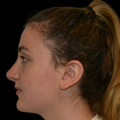 Rhinoplasty Before & After Patient #17207
