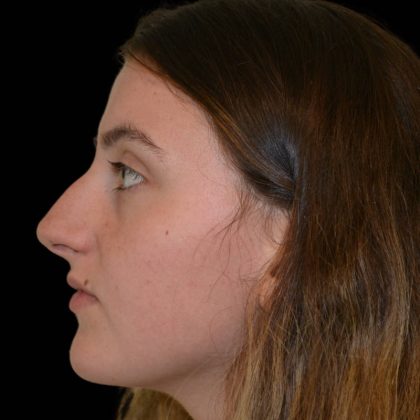 Rhinoplasty Before & After Patient #17207