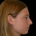 Rhinoplasty Before & After Patient #17212