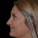 Rhinoplasty Before & After Patient #17223