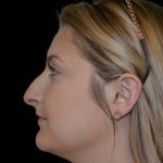 Rhinoplasty Before & After Patient #17223