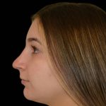 Rhinoplasty Before & After Patient #17230