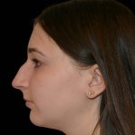 Rhinoplasty Before & After Patient #17230