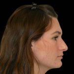 Rhinoplasty Before & After Patient #17242