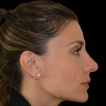 Rhinoplasty Before & After Patient #17247