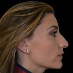 Rhinoplasty Before & After Patient #17247