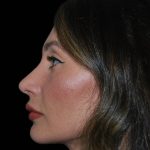 Rhinoplasty Before & After Patient #17252