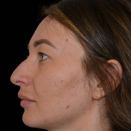 Rhinoplasty Before & After Patient #17252