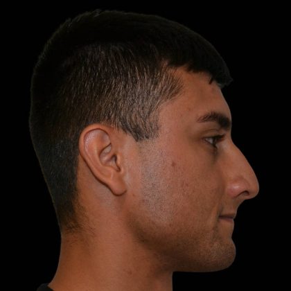 Rhinoplasty Before & After Patient #17259