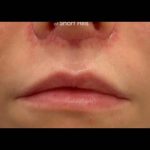 Lip Lift Before & After Patient #17299