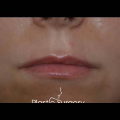 Lip Lift Before & After Patient #17299