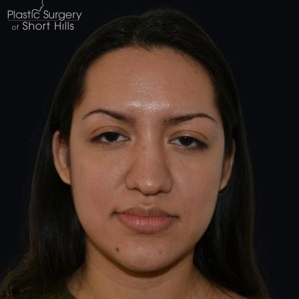 Rhinoplasty Before & After Patient #17362