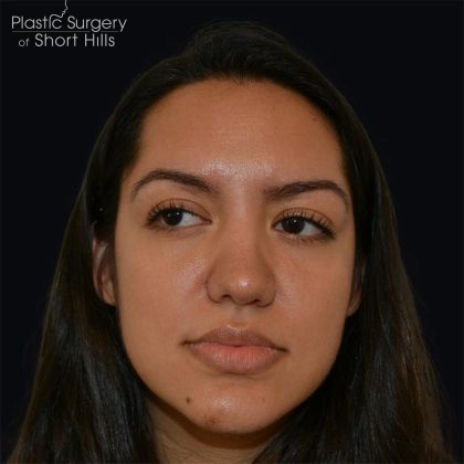 Rhinoplasty Before & After Patient #17362