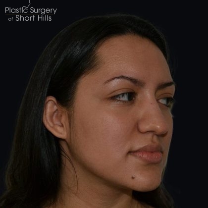 Rhinoplasty Before & After Patient #17362