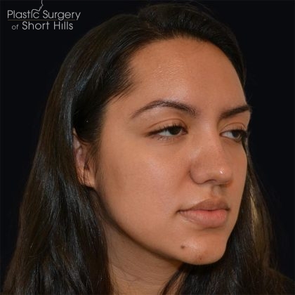 Rhinoplasty Before & After Patient #17362