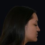 Rhinoplasty Before & After Patient #17362