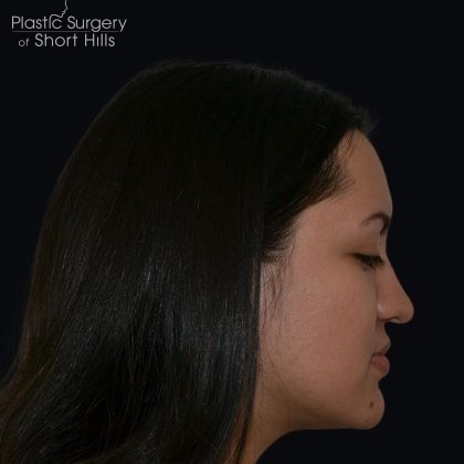 Rhinoplasty Before & After Patient #17362