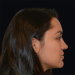 Rhinoplasty Before & After Patient #17362