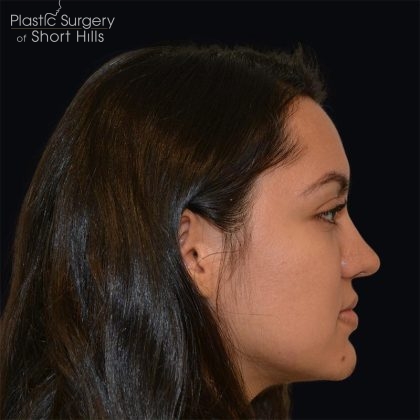 Rhinoplasty Before & After Patient #17362