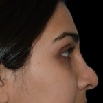 Revision Rhinoplasty Before & After Patient #17344