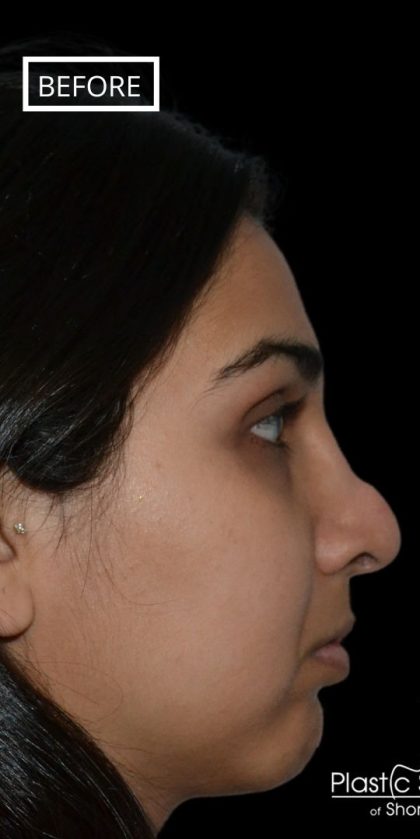 Revision Rhinoplasty Before & After Patient #17344