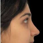 Revision Rhinoplasty Before & After Patient #17344