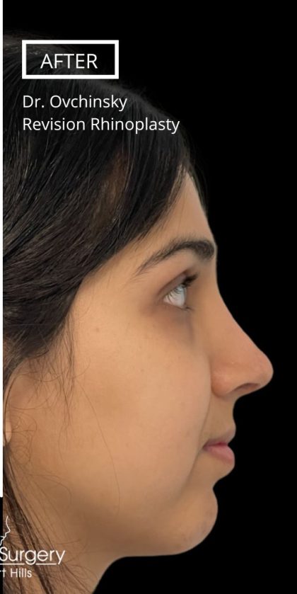 Revision Rhinoplasty Before & After Patient #17344
