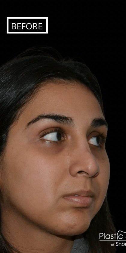 Revision Rhinoplasty Before & After Patient #17344