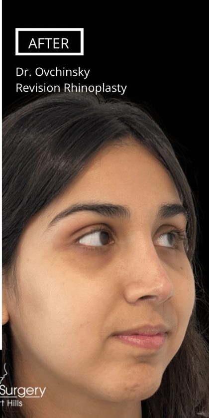 Revision Rhinoplasty Before & After Patient #17344