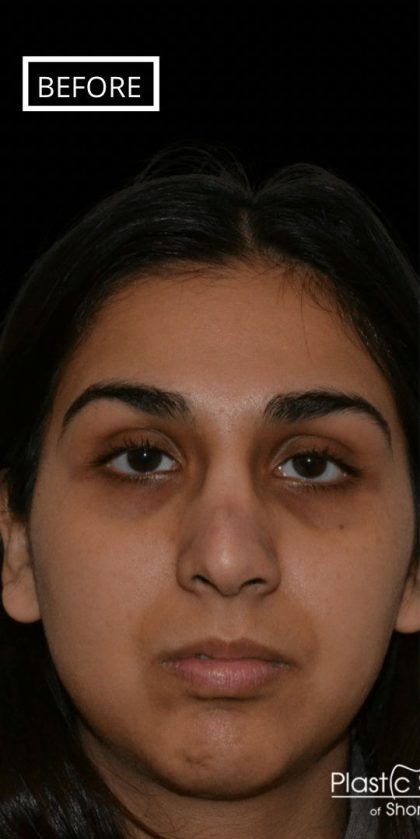 Revision Rhinoplasty Before & After Patient #17344