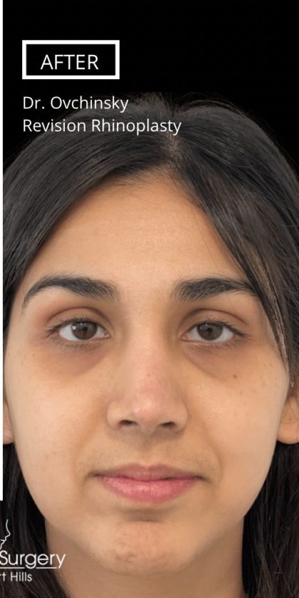 Revision Rhinoplasty Before & After Patient #17344