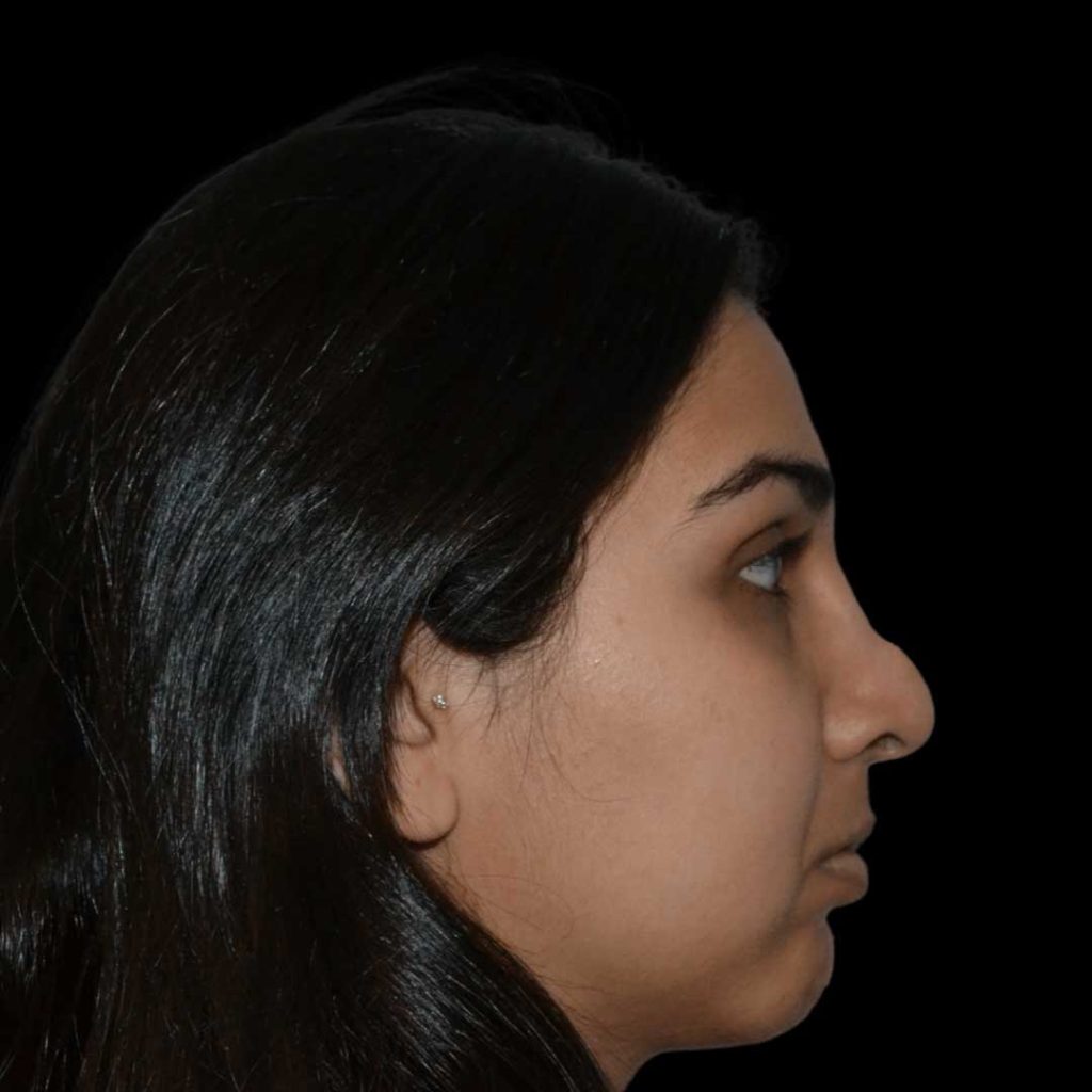 rhinoplasty short hills