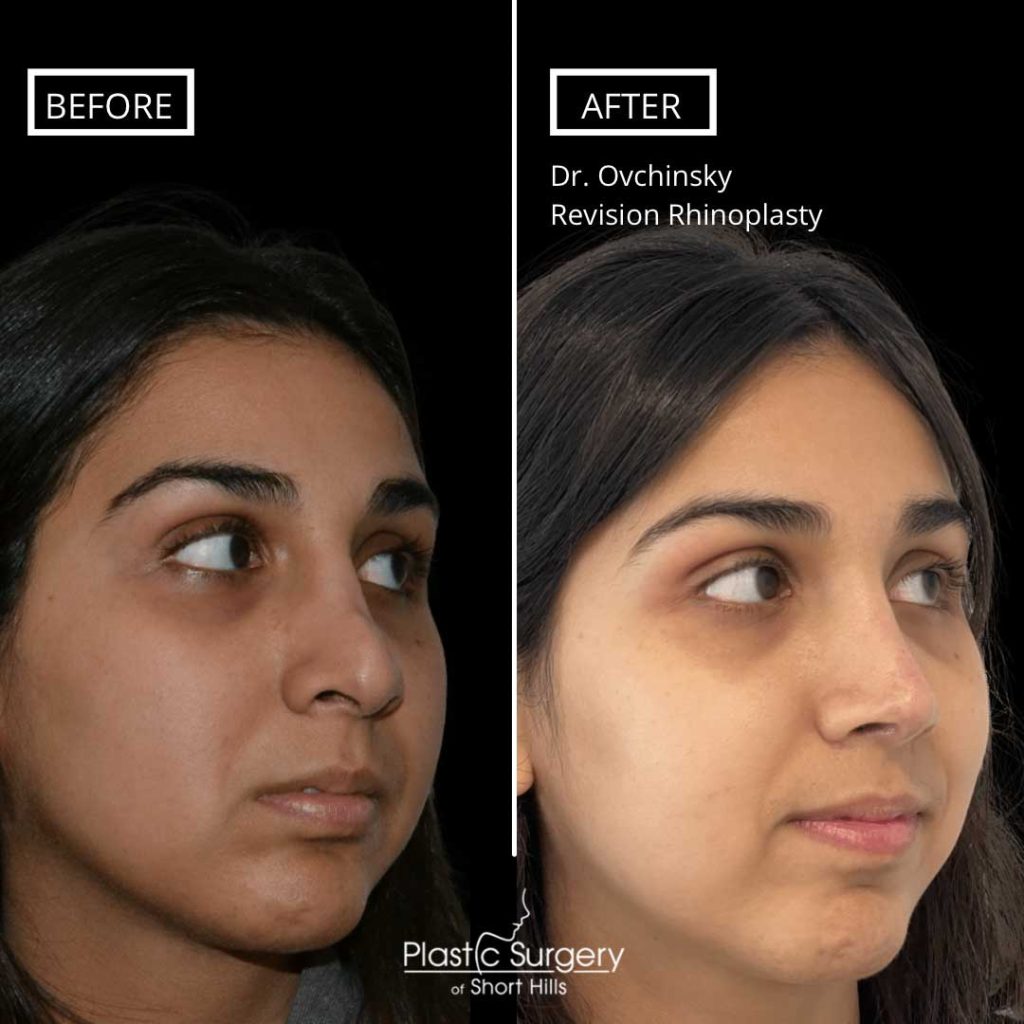 rhinoplasty short hills